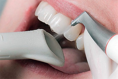 Профессиональная чистка и гигиена всей полости рта, Шведская стоматология